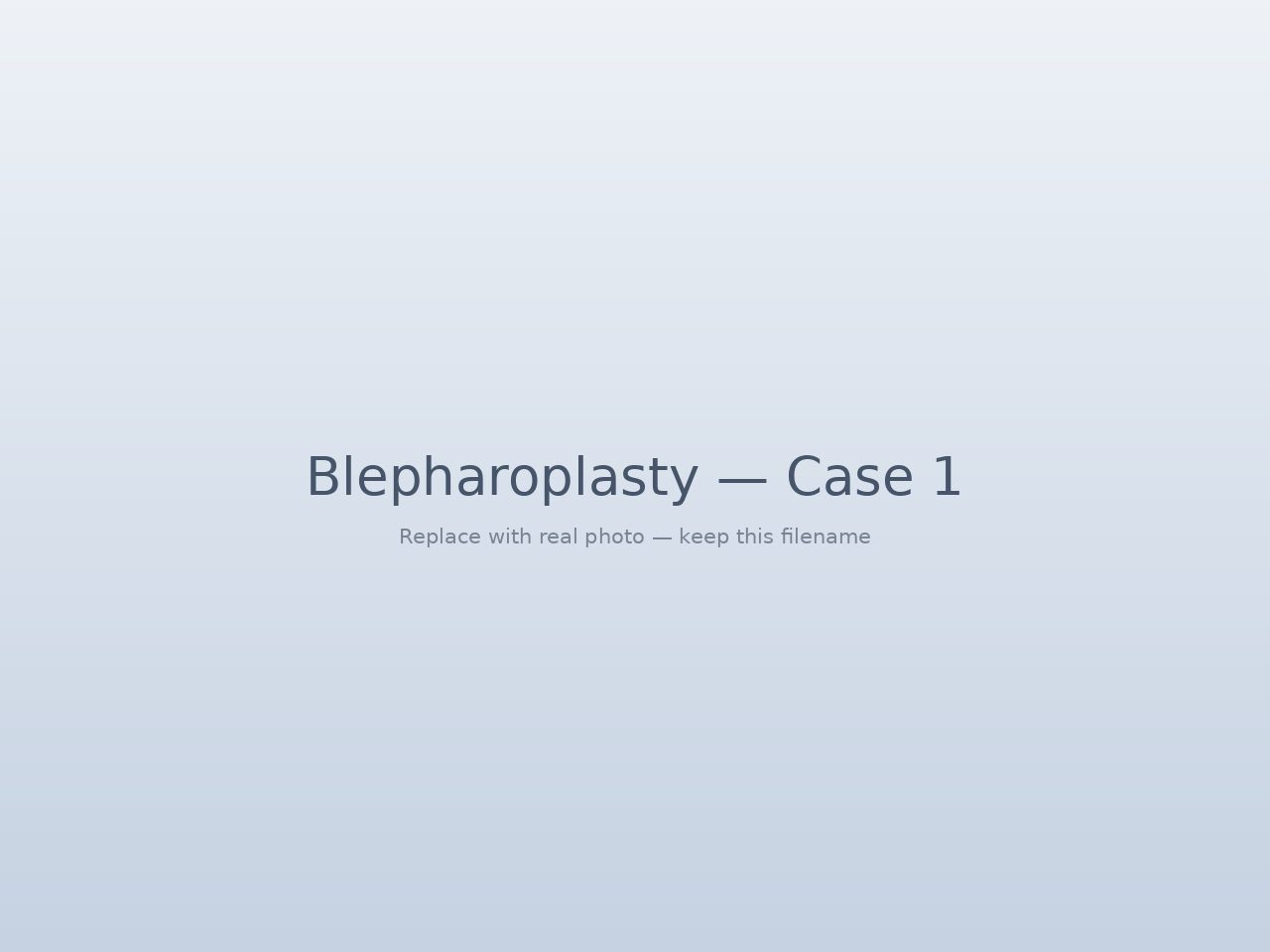 Blepharoplasty before and after — upper eyelid surgery result