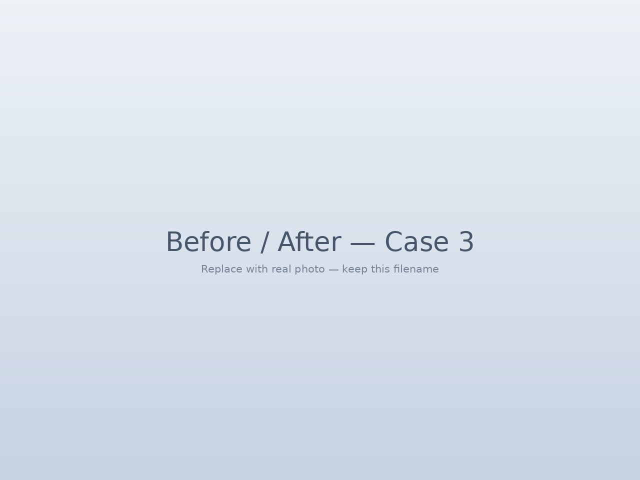 Deep plane facelift with nano fat transfer before and after — Tijuana
