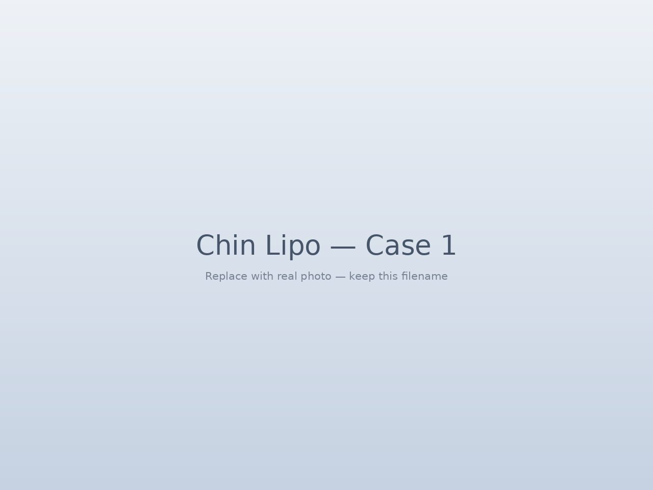 Laser chin lipo before and after — submental contouring result