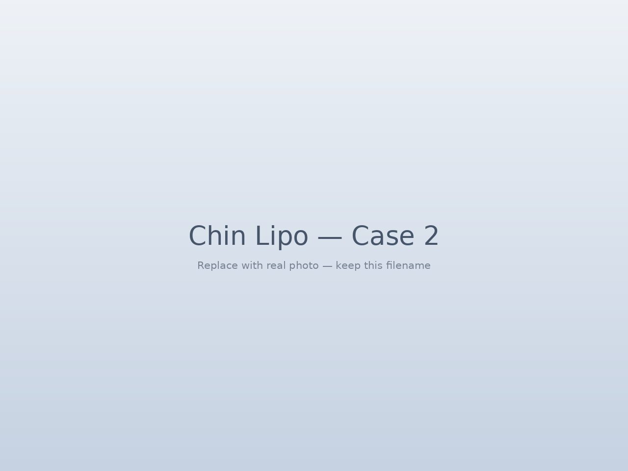 Chin lipo before and after in Tijuana — jawline definition